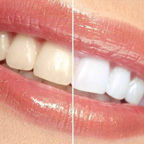 Zähne einer Frau vor und nach der Zahnaufhellung. Mundpflege