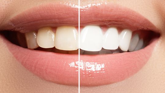 Bleaching vorher und nachher