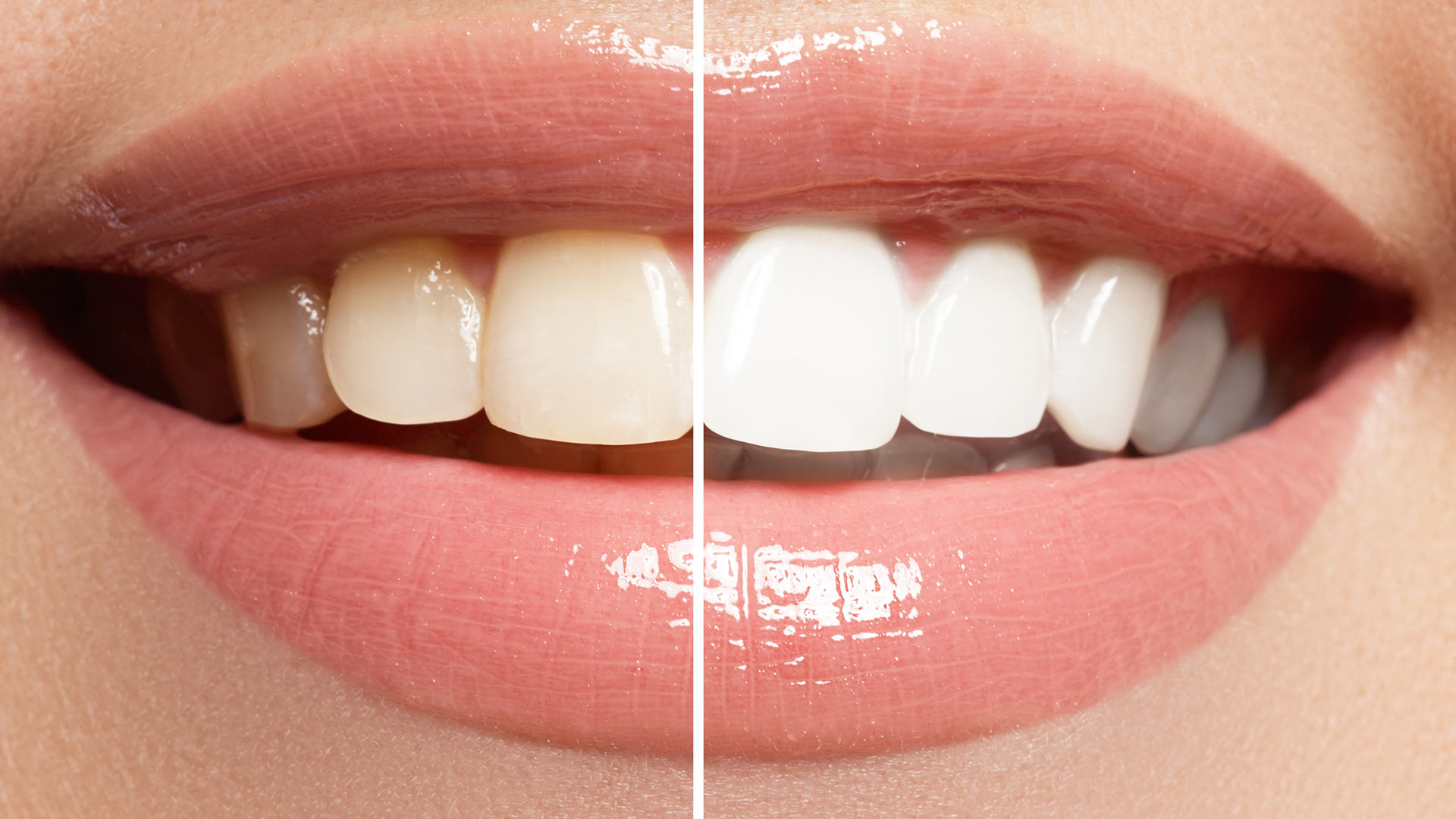 Bleaching vorher und nachher